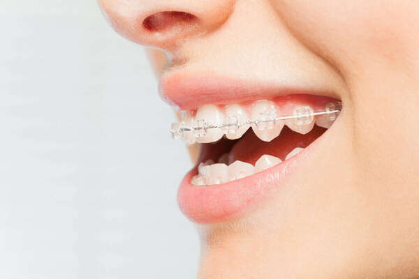 Les sept familles d'appareillages orthodontiques