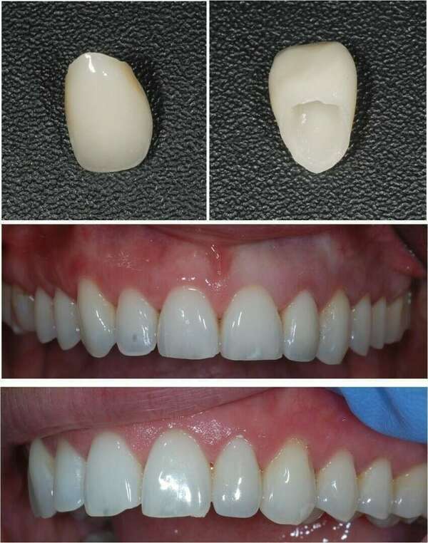 LA COURONNE TOUT CÉRAMIQUE