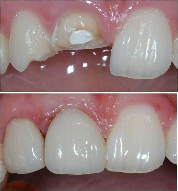 LES FACETTES CÉRAMIQUES