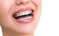 LES APPAREILS ORTHODONTIQUES AUTO-LIGATURANT