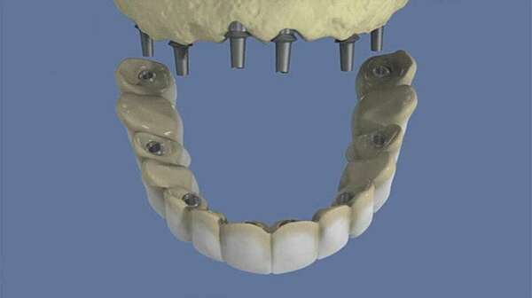 Maxillaire : bridge complet scellé sans fausse gencive