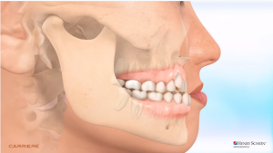 CARRIERE Motion cl III