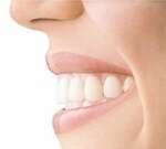 TRAITEMENT PAR ALIGNEURS TRANSPARENTS