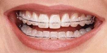 ORTHODONTIE INVISIBLE : L’ORTHODONTIE LINGUALE