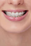 Bagues - Cabinet orthodontie Dr LAIGNEAU et Dr RAFAITIN