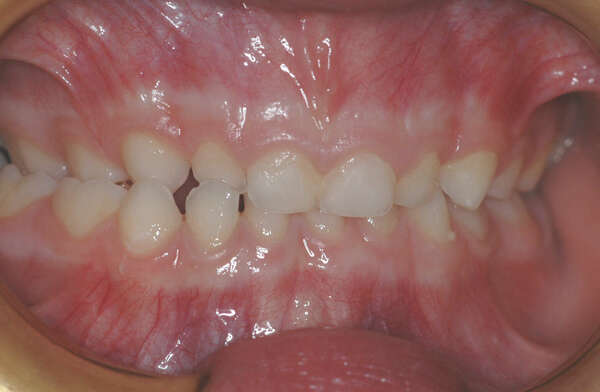 L’OCCLUSION DENTAIRE