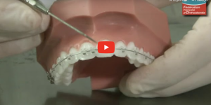 Urgences et décollement bracket