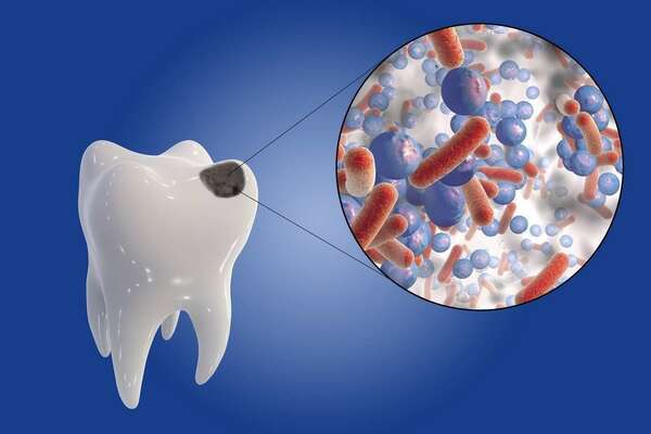 CARIES ET SOINS DES CARIES