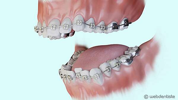 Traitement multi-attaches