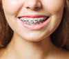 Cabinet d'orthodontie à Saint-Pierre (974) : traitement d'orthodontie pour améliorer la position des dents