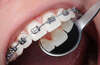 Cabinet d'orthodontie à Saint-Pierre (974) : traitements orthodontiques, bouche avec bagues métalliques