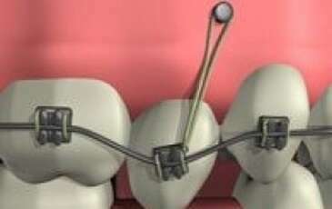 LES MINI-VIS EN ORTHODONTIE