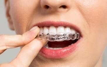 LA TECHNIQUE INVISALIGN® – ALIGN TECHNOLOGY