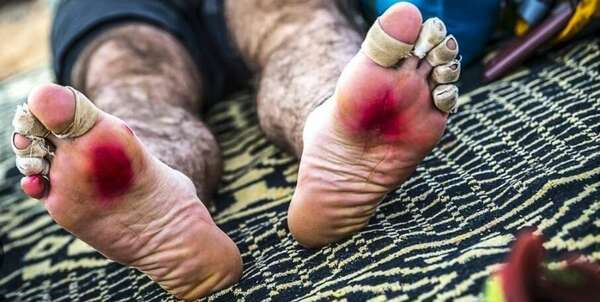préparation-pieds-ampoules-trail-marathon-soins-équipements-course-sport