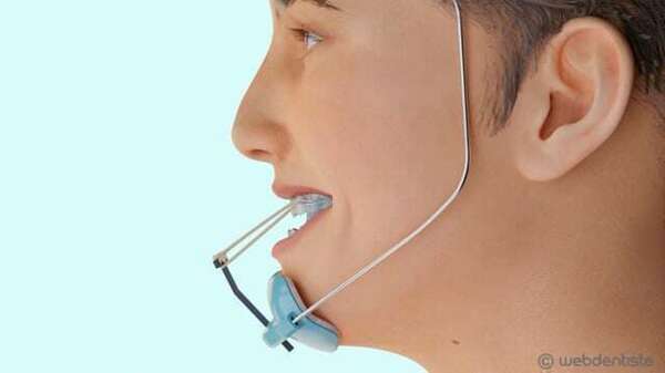 Le masque de delaire - chronomask