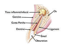 POURQUOI RÉALISER UN TRAITEMENT ENDODONTIQUE ?