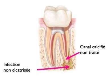 POURQUOI RÉALISER UN NOUVEAU TRAITEMENT ENDODONTIQUE (RETRAITEMENT)