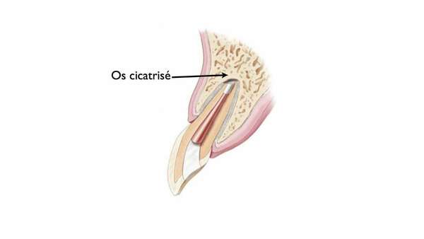 QUESTIONS FRÉQUENTES SUR LA MICROCHIRURGIE ENDODONTIQUE?