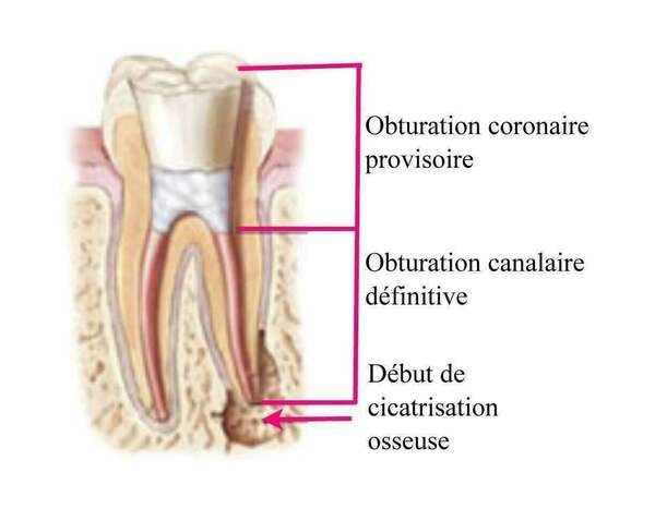 COMMENT SE DÉROULE UN RETRAITEMENT ENDODONTIQUE