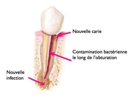 POURQUOI REALISER UN NOUVEAU TRAITEMENT ENDODONTIQUE (RETRAITEMENT)