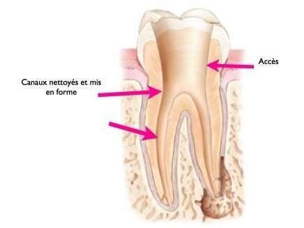 COMMENT SE DEROULE UN RETRAITEMENT ENDODONTIQUE