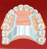 PROTHESES AMOVIBLES PARTIELLES