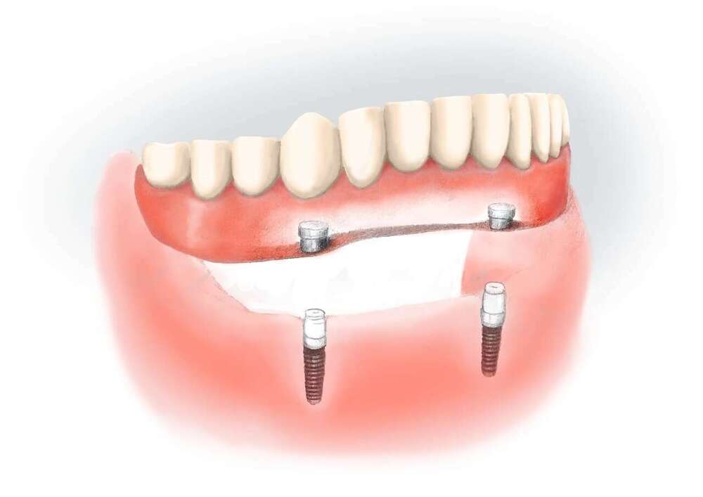 STABILISATION DES PROTHESES AMOVIBLES COMPLETES