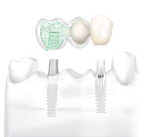 REMPLACER PLUSIEURS DENTS