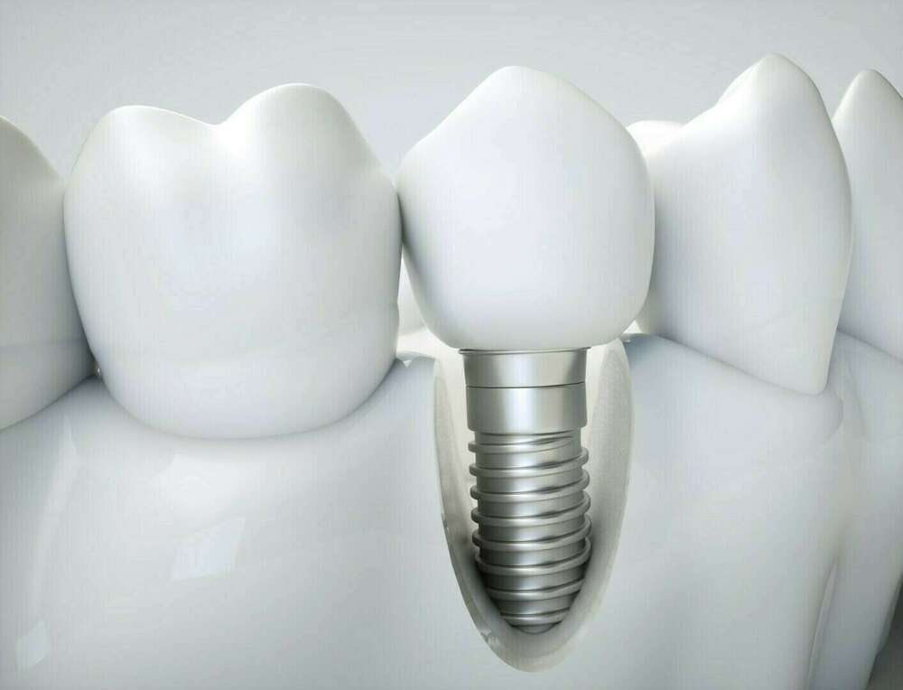 IMPLANTS DENTAIRES : VOS QUESTIONS
