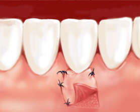 GREFFE GINGIVALE A VISEE ESTHETIQUE