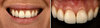 Cas 2: Blanchiment et Facettes céramiques - Après