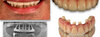 Cas 3: Extraction implantation et Bridge complet céramique Maxillaire sur armature en zircone - Après