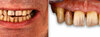 Cas 3: Extraction implantation et Bridge complet céramique Maxillaire sur armature en zircone - Avant