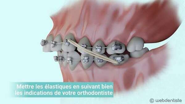 Les élastiques de classes ii et iii