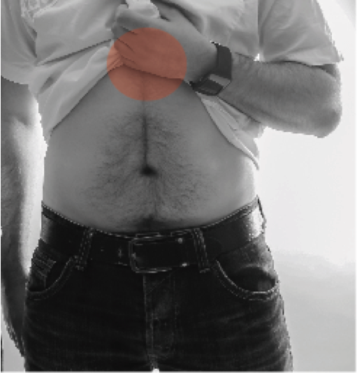 Le Magnétisme et la hernie hiatale