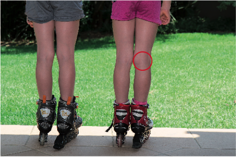 Le Magnétisme et le kyste poplité