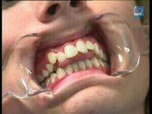 CORRECTION POUR LE PORT DE L'APPAREIL