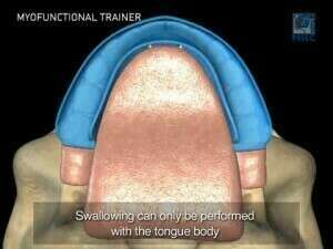 EXERCICES D'ORTHOPHONIE  RÉÉDUCATION DE LA LANGUE