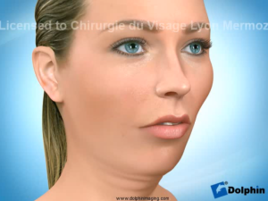 Traitement chirurgical des Classes 2