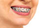 Bagues, Dr. Laurent PETITPAS, Orthodontiste à pont-à-mousson