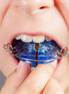 Traitement enfants, Dr. Laurent PETITPAS, Orthodontiste à pont-à-mousson