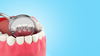 pratique lingual - orthodontie invisible au cabinet du Dr. Laurent Petitpas