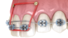Mini-vis en orthodontie, Pont-à-Mousson - Dr Petitpas