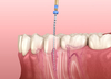 endodontie, cabinet dentaire Le Beaupre, Beaucaire (30300)