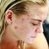 acnee probleme de peau