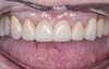 réhabilitation esthétique par facettes cas 5 - après