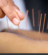 Personne allongée dos avec aiguilles acupuncture séance cabinet