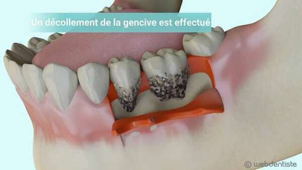 Le traitement chirurgical de la parodontite