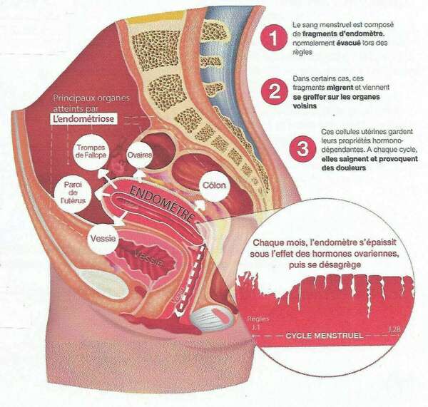 L'ENDOMETRIOSE