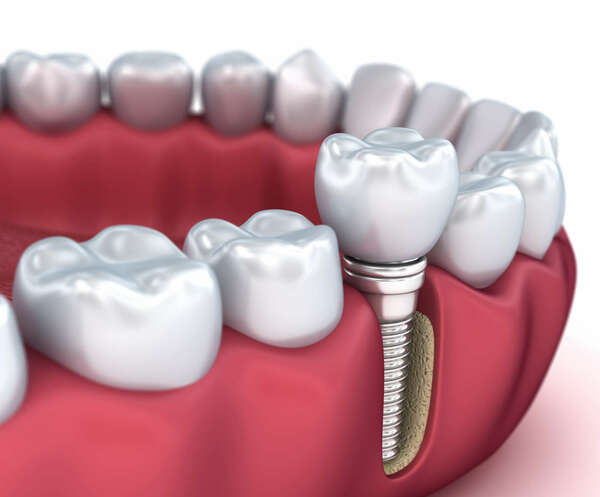 Les implants dentaires : restaurer votre sourire durablement